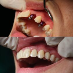 Implantologia presso lo studio dentistico D'ambrosio jpg