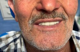 Implantologia dentale con impianti Nobel Biocare