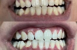 Sbiancamento BlancOne Click