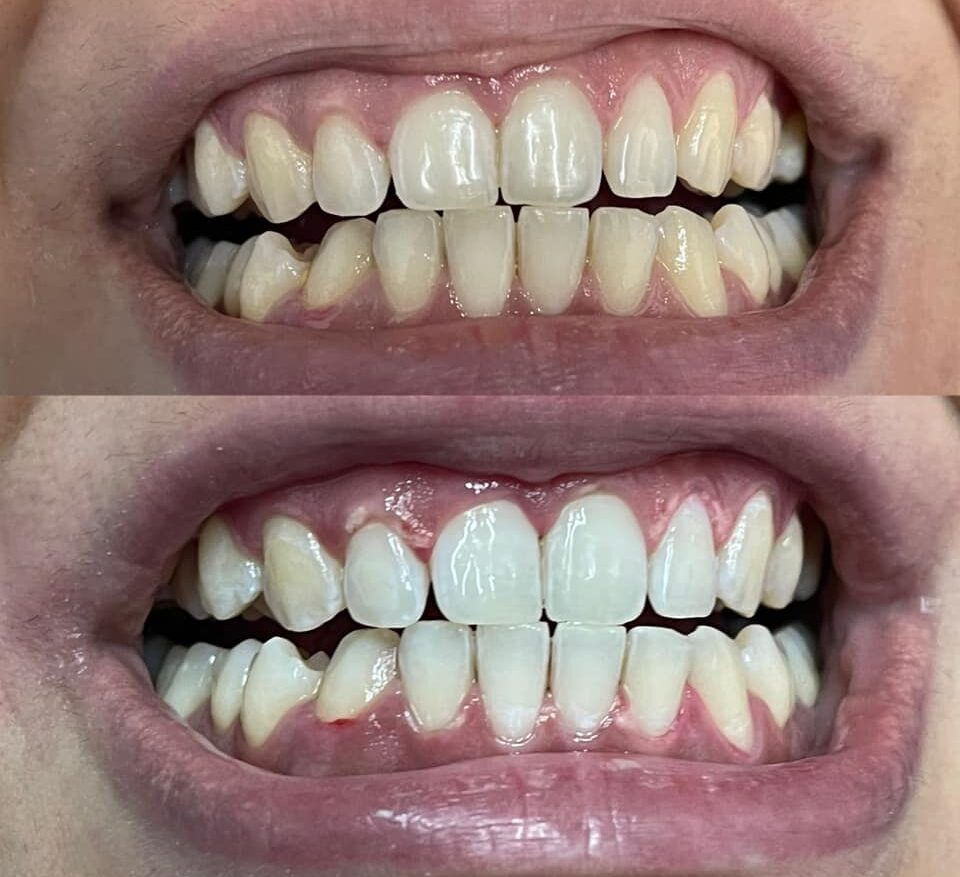 Sbiancamento Blank one