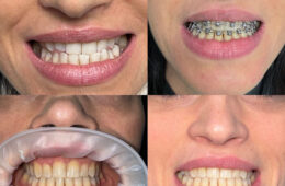 Ortodonzia Fissa risultati