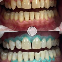 studiodentisticodambrosio_sbiancamento-professionale-ultra